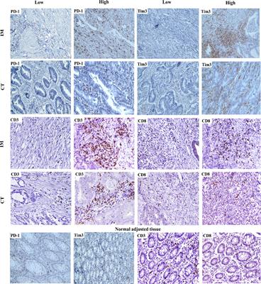 Tim3 and PD-1 as a therapeutic and prognostic targets in colorectal cancer: Relationship with sidedness, clinicopathological parameters, and survival